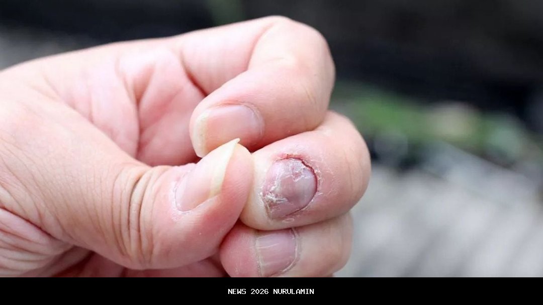 Tanda-Tanda Tangan dan Kuku yang Mengungkap Masalah Kesehatan Serius