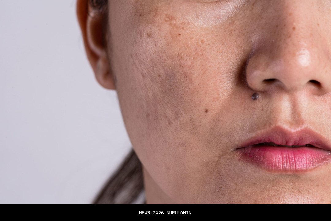 Penyebab, Pengobatan, dan Tips Efektif Mengatasi Melasma Wajah